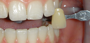 After Tooth Whitening