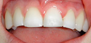 After Tooth Whitening