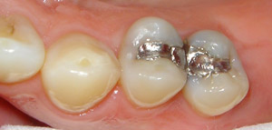 Before Filling Replacement
