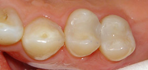 After Filling Replacement