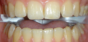 Before Tooth Whitening