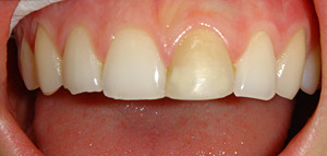 Before Tooth Whitening