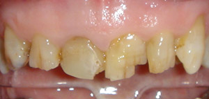 Before Veneer