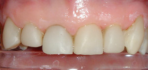 After Veneer